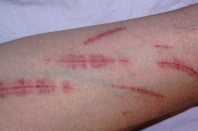Come Sono Le Braccia Di Un Tossico