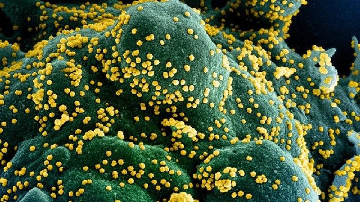 Particelle virali del SARS–CoV–2 su cellule umane. Credit: NIAID