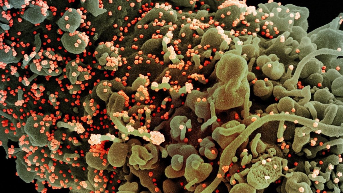 Particelle virali del coronavirus su cellula umana. Credit: NIAID