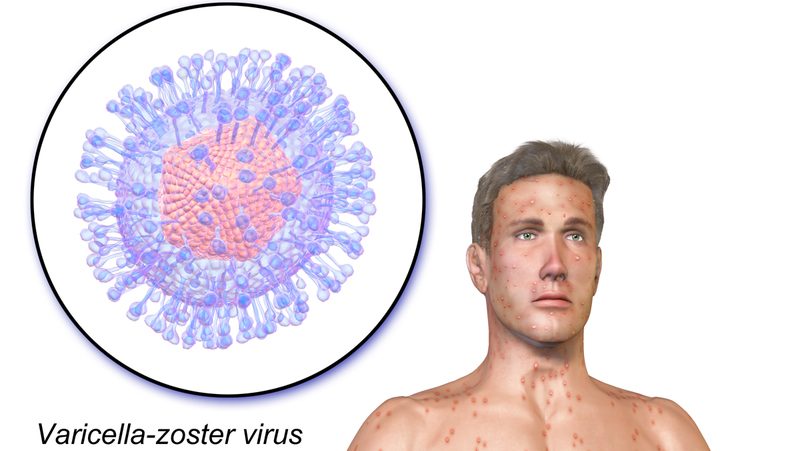 Variicella Finalmente sappiamo perché il virus della varicella può aumentare il ...