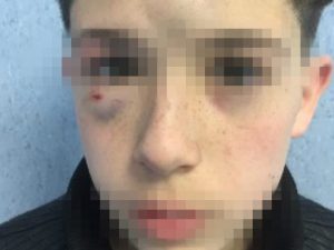 Bambino di 13 anni massacrato di botte dai bulli a Mugnano