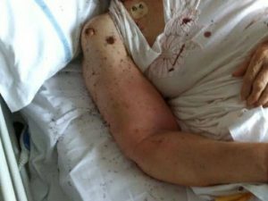 Formiche nel letto d'ospedale, parla la paziente: "Devo ringraziare la Madonna"