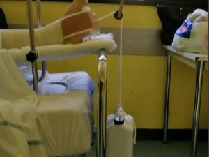 Il sistema per tenere in trazione la gamba del paziente all’ospedale Cardarelli (Foto Facebook/Figli delle chiancarelle)