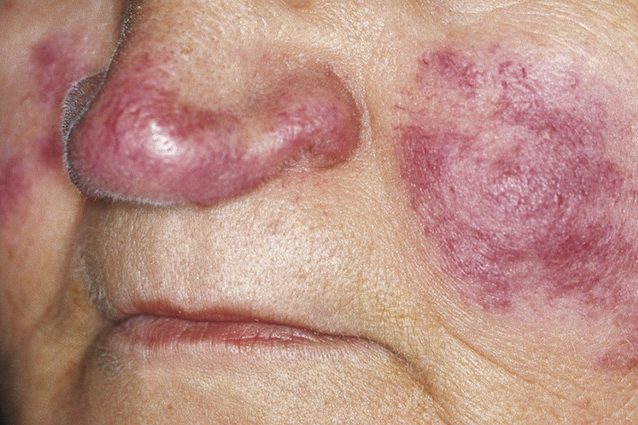 Lupus