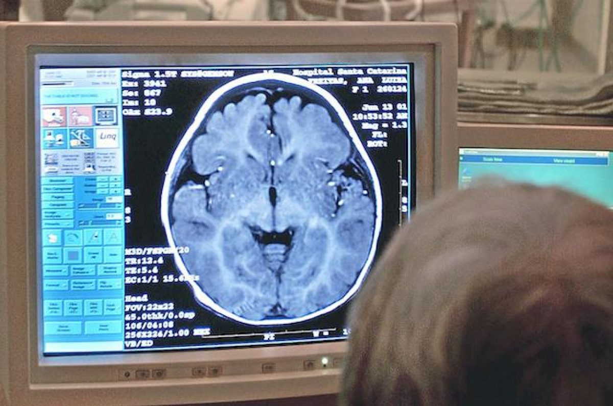 Come Capire Se Hai Un Tumore Al Cervello