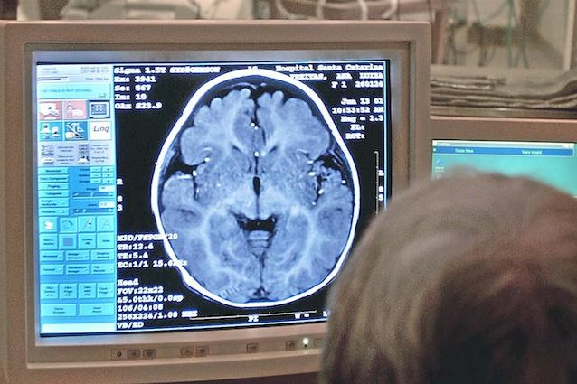Gli ultrasuoni aprono un varco nel cervello per raggiungere i tumori