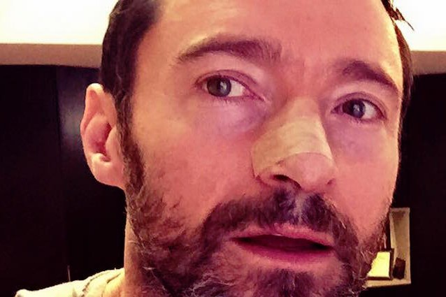 Basalioma: cos'è e come si cura il tumore di cui soffre Hugh Jackman