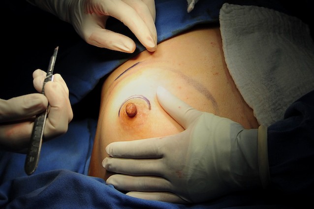 Cancro al seno: nuove speranze grazie alla mastectomia preventiva che preserva i capezzoli