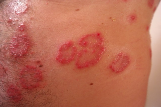 Psoriasi: finalmente un farmaco davvero efficace per contrastarla