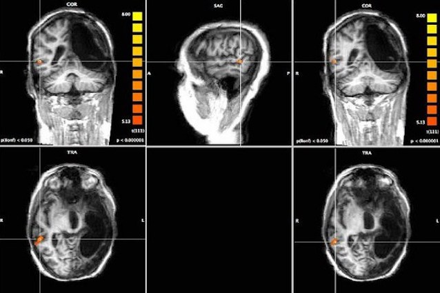 Ricerca italiana: torna a parlare due lingue con solo “mezzo” cervello