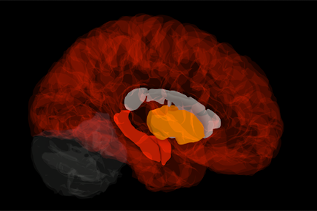 Scoperta la firma genetica all'origine dell'Alzheimer