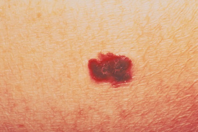 Tumori: italiani scoprono come fermare il melanoma