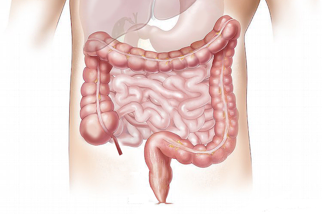 Morbo di Crohn, cos'è e come si cura la malattia dell'intestino