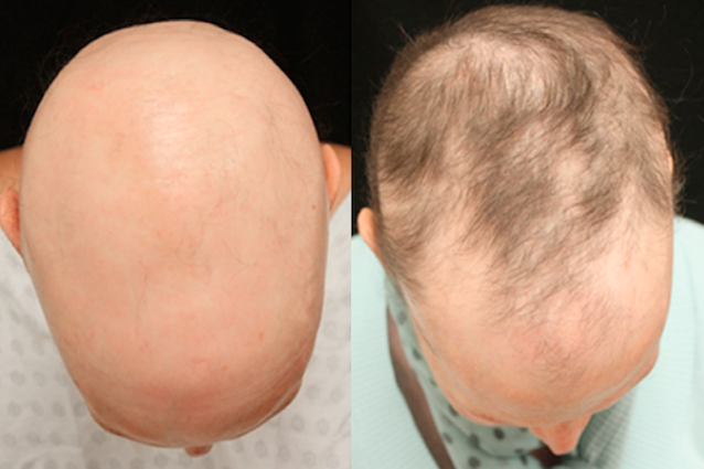 Alopecia: come funziona il farmaco per l'artrite reumatoide che fa ricrescere i capelli