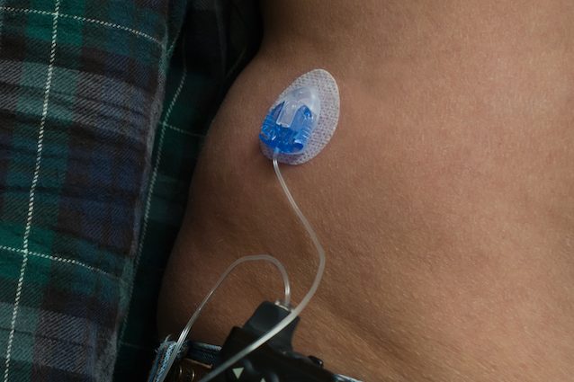 Diabete 1: basta iniezioni grazie al “pancreas artificiale” che regola da solo l'insulina