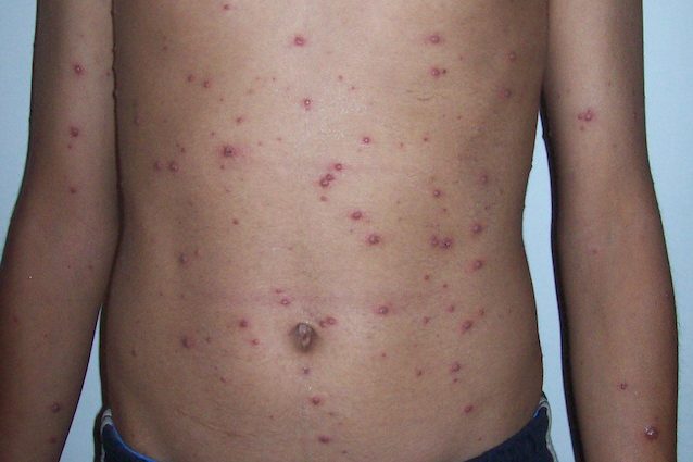 La varicella è infettiva e contagiosa: i sintomi, la cura, il vaccino e le complicanze