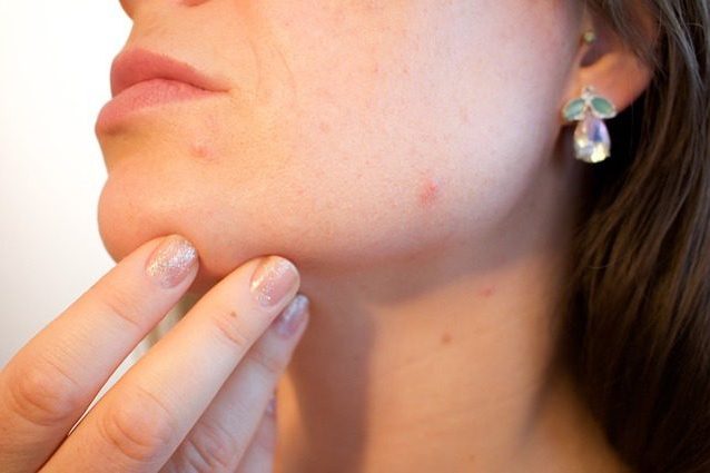 Un vaccino contro l'acne: è la fine di un incubo per gli adolescenti