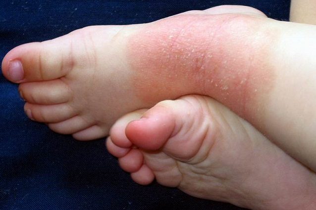 Purè vegetale a dermatite atopic