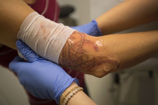 In arrivo le bende 'intelligenti': comunicano al medico lo stato della ferita via internet