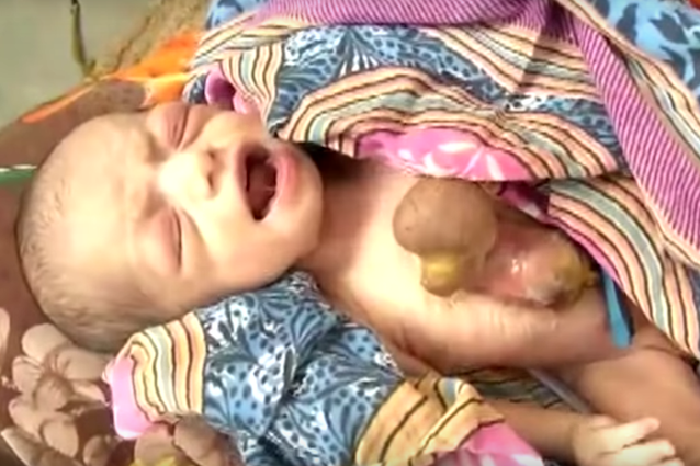 Hemlata, la bambina con il cuore che batte fuori dal petto: cos’è l’Ectopia Cordis