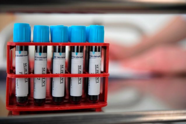 Test del sangue e Sindrome di Down: cos’è lo screening prenatale non invasivo basato sul DNA