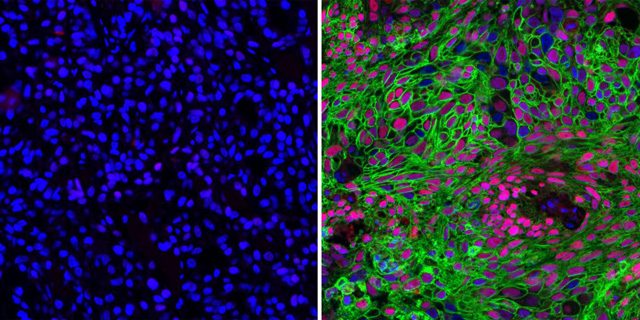 A destra un carcinoma a cellule squamose, dove in verde è evidenziata la proteina GLUT1: credit Università del Texas