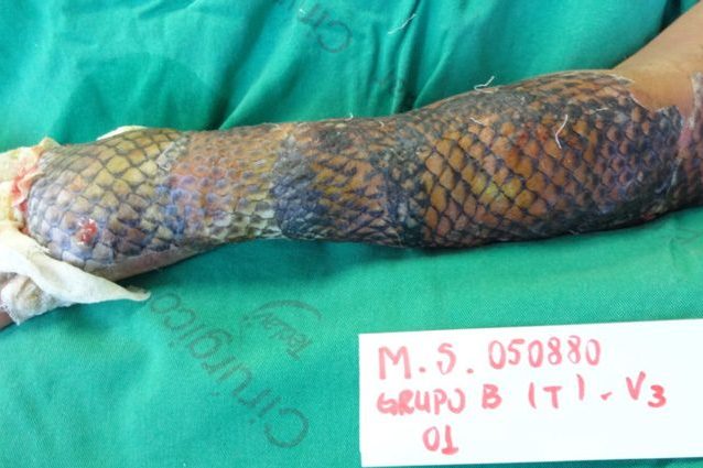 La pelle del pesce tilapia cura le ustioni: come fa a ridurre il dolore