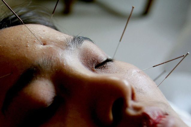 L'agopuntura contrasta il dolore come i farmaci