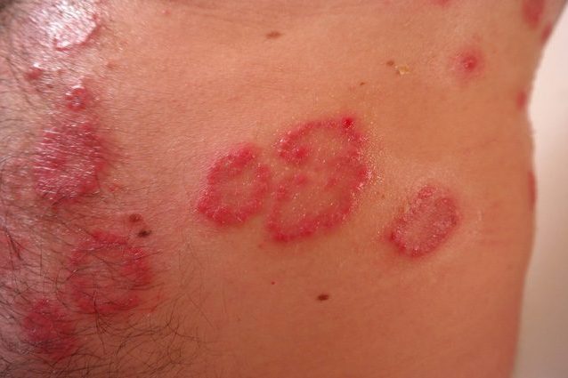 Artrite psoriasica: due nuovi farmaci efficaci contro la malattia