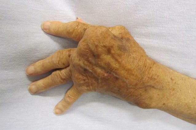 artrite psoriasica e disfunzione erettile