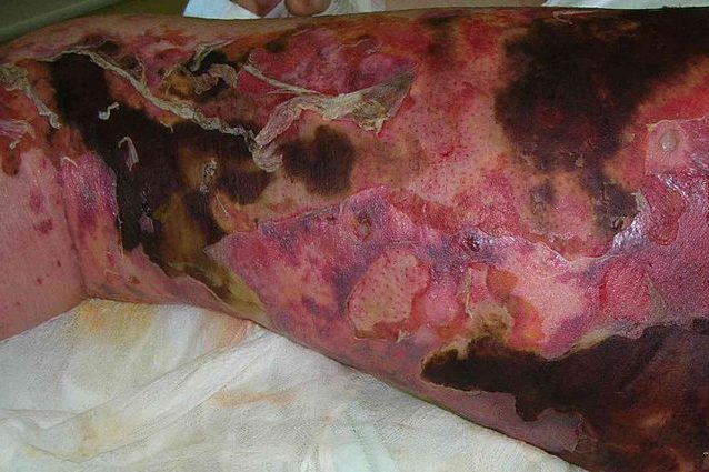 Fascite necrotizzante e 'batteri mangiacarne': cos'è l'infezione che distrugge l'organismo