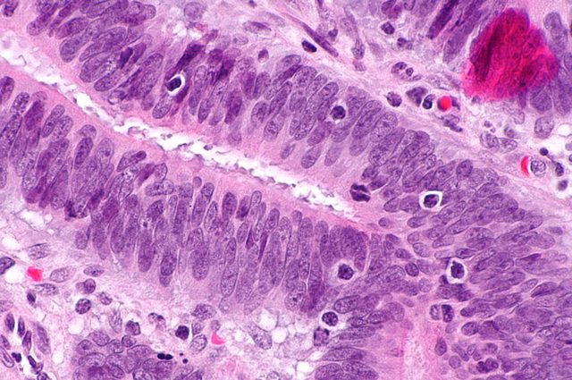 Terapia rivoluzionaria con cellule immunitarie TIL uccide il cancro al seno: cosa sono