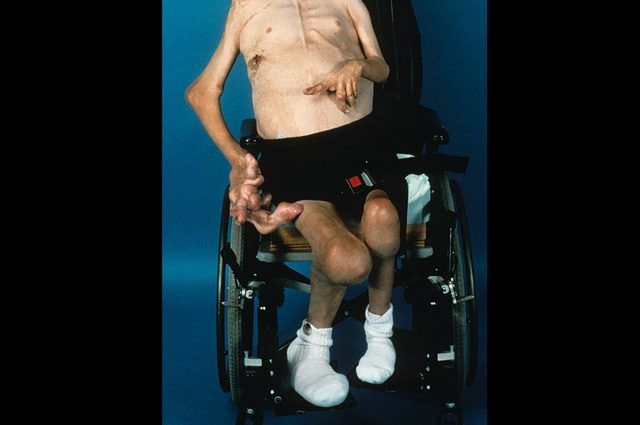 Cos'è la sindrome di Proteo, la rara malattia che provoca