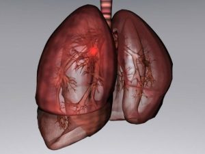 effetti collaterali del trattamento laser del cancro alla prostata