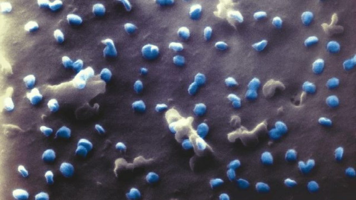 Il coronavirus SARS–CoV–2 (in blu) aggredisce una cellula renale. Credit: Università di Bielefeld / N. Frese