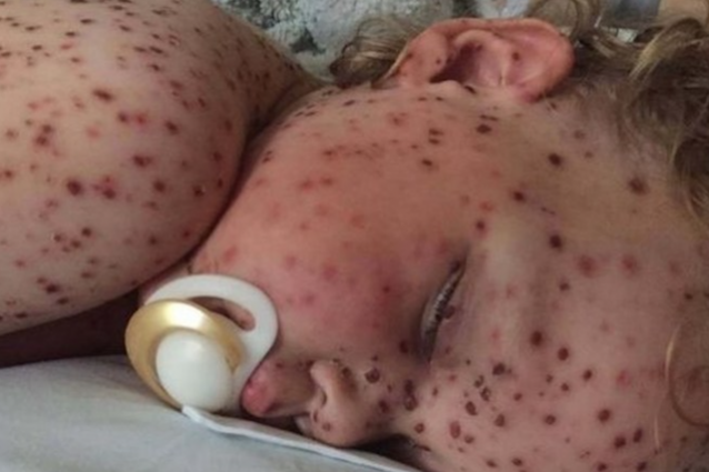 "Questo bambino ha il cancro", ma è solo varicella: Facebook indaga sulla bufala