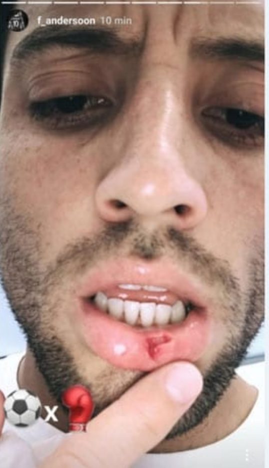 Felipe Anderson su Instagram ha mostrato il taglio al labbro.